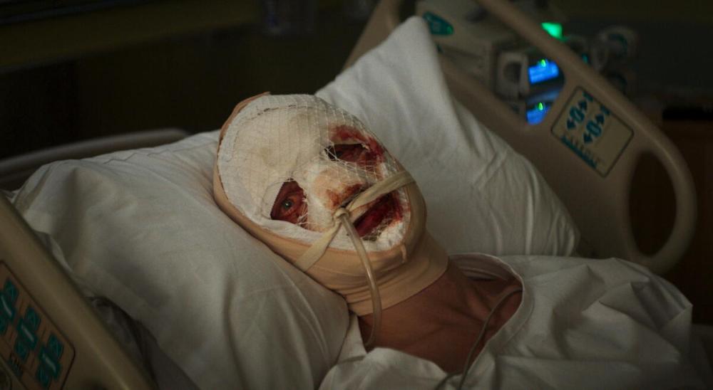 A person in a hospital bed with their head wrapped in bandages, showing signs of injury, and connected to medical equipment.